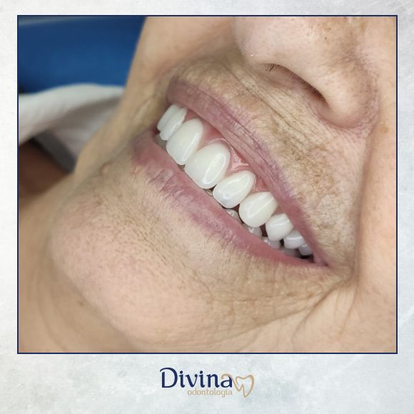 Caso clínico Divina Odontologia - Tratamento odontológico 4