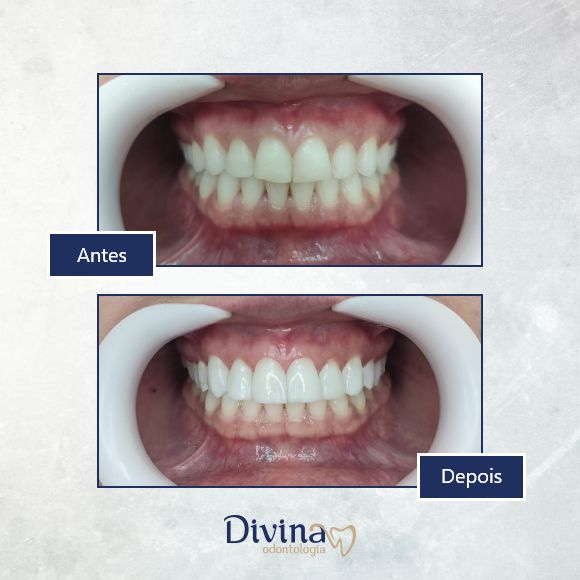 Caso clínico Divina Odontologia - Tratamento odontológico 5